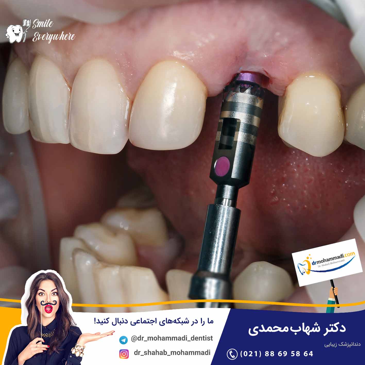 ایمپلنت بیماران دیابتی چگونه است آیا خطرناک است؟ - کلینیک دندانپزشکی دکتر شهاب محمدی